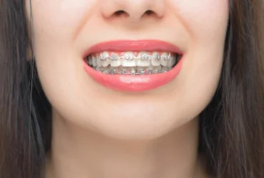 Self-Ligating Braces