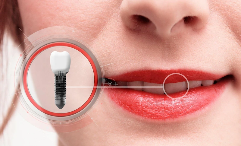 Affordable Implant Dentistry