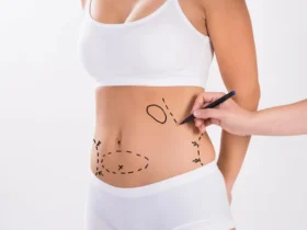 Tummy Tuck With Lipo